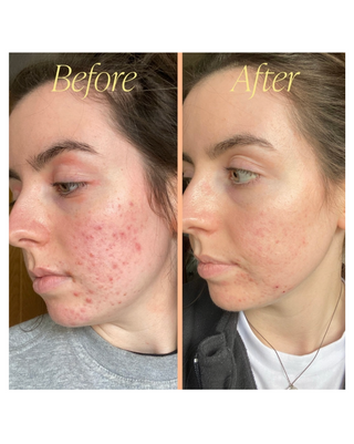 Ally Recovery Blemish Facial Oil